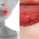 설암 | 설암에 좋은 음식으로 매일 챙기는 식단 관리 방법