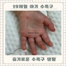 19개월 아기 수포 붉은반점 슬기로운 수족구 생활 가정보육 식사 간식