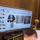 모더함의원 | 모더함 의원:헤어라인 모발이식 상담후기