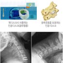 경추질환(후종인대골화증,경추공협착증) 이미지