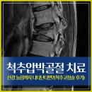 민상혁기둥정형외과의원 | 척추압박골절 치료, 신경 눌림까지 나타난다면?(척추고정술 후기)