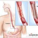 건강상식 정보 (심근경색증) 이미지