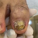 수원-1590 | 수원발톱무좀 레이저 없이 관리 받고 온 후기