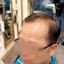 김호증모가발by헤어리서치 이미지