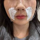 피어봄의원 | 팔자 쥬베룩볼륨 2cc 내돈내산 후기 강남피부과 효과 통증 가격