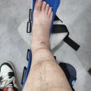 유호체육관 | 발목 인대파열 한달차 후기 - 물리치료 종류, 체외충격파 후기