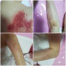 아리따움연일점 | 피부가려움증으로 고생하시는분의 동심기테라피전신 후기입니다