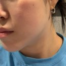 (주)튠바이오3 | 강남역 피부과 리프팅, 듀얼튠페이스 + 튠라이너 솔직 후기 (전후 비교, 다운타임은 일단 없!!)