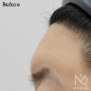 디파인피부과의원 | 이마필러 부작용 후기 (7번을 재시술하고 녹였던 피부 치료사례)