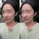 압구정시골쥐 | 압구정피부과 울쎄라 내돈내산 후기