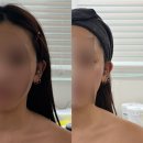 유얼핏 | 의정부 피부관리 잘하는 곳 유얼핏 에스테틱 의정부본점, 1회만에 작아지는 착붙턱 관리 후기