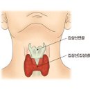 갑상선미분화암 (Undifferentiated thyroid cancer) 이미지