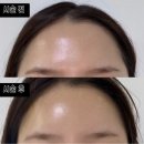 박리 | [서울/경기도] 박리 안 하는 이마필러 내돈내산 만족 후기