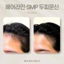 광주 헤어라인 SMP 두피문신 바람 불어도 자신있는 예쁜 이마 후기