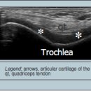 근골격계sono자료 Femoral trochlea 이미지