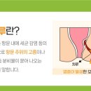 치루개 이미지