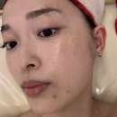 세실로 69번길 | 부산슈퍼젝션 슈퍼젝션1위 에이스뷰티 해운대에서 슈퍼젝션 블루 받고 온 찐 후기