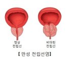 양성 전립선 비대증 (Benign prostatic hyperplasia) 이미지