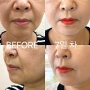 강남역 성형외과 50대 엄마 쥬브젠 자가진피재생술 팔자주름 후기(가격 흉터 지속기간 등)