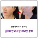 신논현 피부과 쁨의원에서 울쎄라대신 울트라인 리프팅 300샷 후기