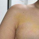 11650-17-22-7 | 겨드랑이 혹 부유방 유선제거 후기 경과 7일차~22일차 주의할점