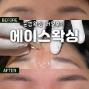 서울에이스병원 | 매끈매끈하다 매끈매끈한! 눈썹 만들기 &#39;에이스왁싱&#39; 리얼 후기, 페이스왁싱 아픔 정도?