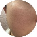 원의원 | 구미 프렌즈의원 잡티제거 후기｜90만원 피부과 안 가고 여기 온 이유