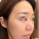 압구정로데오피부과에서 옥시리버스로 산소테라피 피부관리한 후기