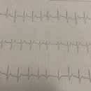 Sinus arrhythmia인가요 APC인가요? 이미지