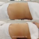 루엔호텔 | 천안바디관리 엘루엔에스테틱 천안점 복부관리 후기