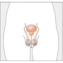 전립선염 전립선 비대증 이미지