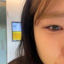 천안 나안과 에서 눈 안에 피지 제거하고 왔어요. 기름샘 피지 제거👀