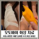 레노메디 | 오토바이 배기통 머플러 화상 베트남 하노이 화상치료병원 후기