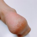 발뒤꿈치각질 , 각질제거기 추천 : 앙쥬앙 샤이닝 풋글래스 리얼후기