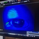 한국사회복지회관 르네상스타워 | 아기 각막 긁힌 상처 회복기, 검은동자에 긁힌 상처가 남..ㅜㅜ (아기 손톱 관리를 잘하자...)