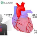 햡심증 증세와 치료 방법 이미지