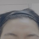 청담피부과 이마필러 후기 자연스러운 라인으로 이미지 바꾸기