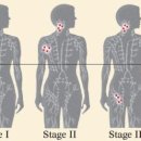 소아암, 생의 한가운데서 만나다 9 - 림프종의 병기(Staging)와 카테고리(categories) 이미지