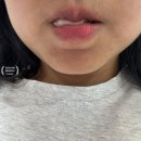 내돈내산 잇몸 이식수술 후기, 일주일 식사 기록