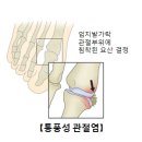 통풍 이미지