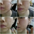 [로나스 동안에센스, 톡스볼륨필러 로나스 톡스 볼륨 필러 후기]