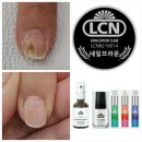 변색된 분당문제성손톱 원스톱 관리로 한번에 복원하기