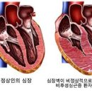 비후성 심근증이란? 증상 수술 치료제 이미지