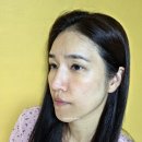 아람 바이오시스템(주) | 부산 서면 한의원 스킨부스터 라보센 바이오좀 후기 (콜라겐생성+잔주름)