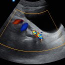 [비뇨기계] Lt. lower ureter stone 이미지