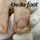 손안의 건강지도(손 자극법) | [On:Re foot] 독일 유명한 문제성 손 발톱 풋제품 "게월" 도대체 뭐가 좋은 걸까? 제품 사용 후기