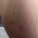 365MC의원 | 365mc 노원점에서 dca밉살주사 맞은 후기