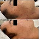 아임스킨 | 아임스킨 관리후기 10탄(여드름)