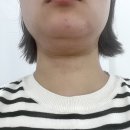 강남예일미의원 | 신사 뷰티앤영의원에서 뷰컷주사+온다6만줄로 이중턱 삭제한 후기