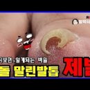 내성발톱 치료 영상 좋아하는 사람 이미지